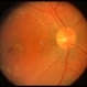 Possible CMV Retinitis with Frosted Branch Angiitis
